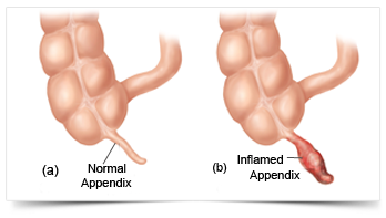 Laparoscopic Appendectomy,Laparoscopic Cholecystectomy,Laparoscopic Hernia Surgery Jalandhar