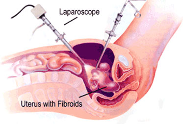 Hysteroscopy for Septum Jalandhar