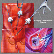 Laparoscopic Specialist Jalandhar